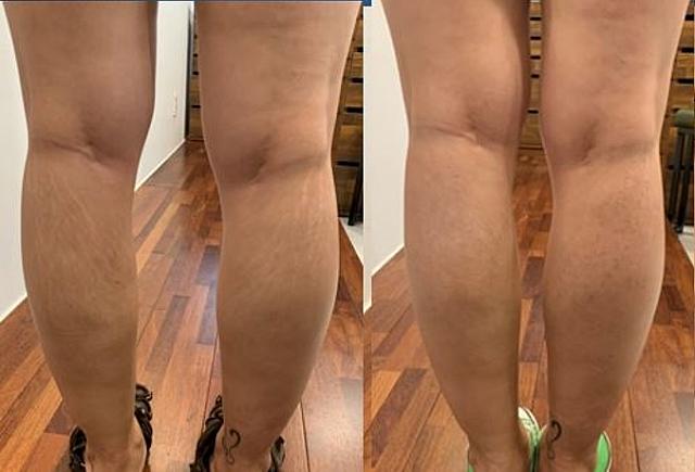 ふくらはぎのストレッチマーク/急激な体重の変化や成長や妊娠線など目立たなくさせるケア。<br>左・施術前、右・一か月後