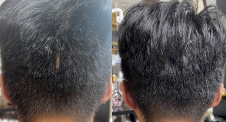 後頭部の傷跡の部分/頭髪があるように見せることができるケア