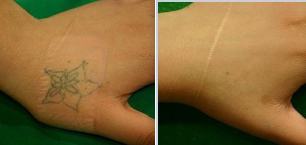 ファッションタトウ除去／ 数回施術