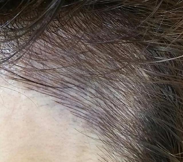 ヘアライン 施術例