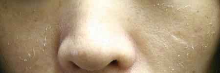 薄皮が剥ける過程