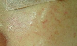 I2PL後すぐ<BR>色素の濃い部分に反応して、少し赤くなっています。