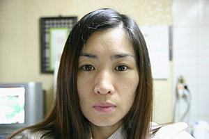 １０日後<BR>薄皮が完全に剥け切った状態。